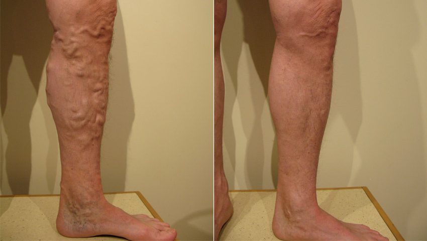 Krampfadern Mit Laser Behandeln Vorher Nachher Dermatologie Hanau